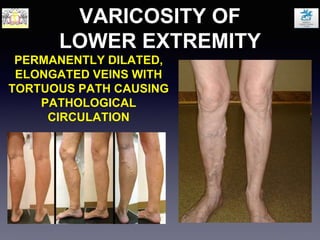 VARICOSITY OF
LOWER EXTREMITY
PERMANENTLY DILATED,
ELONGATED VEINS WITH
TORTUOUS PATH CAUSING
PATHOLOGICAL
CIRCULATION
 