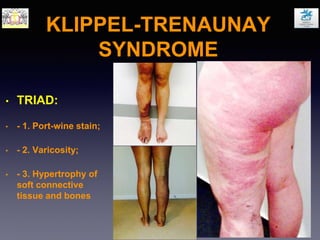 KLIPPEL-TRENAUNAY
SYNDROME
• TRIAD:
• - 1. Port-wine stain;
• - 2. Varicosity;
• - 3. Hypertrophy of
soft connective
tissue and bones
 