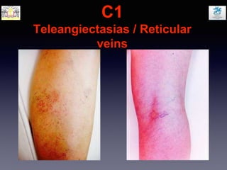 C1
Teleangiectasias / Reticular
veins
 
