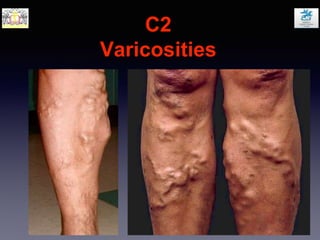 C2
Varicosities
 