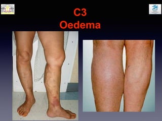C3
Oedema
 