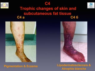 C4
Trophic changes of skin and
subcutaneous fat tissue
C4 a C4 б
Lipodermatosclerosis &
Atrophie blanche
Pigmentation & Eczema
 