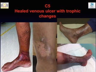 C5
Healed venous ulcer with trophic
changes
 