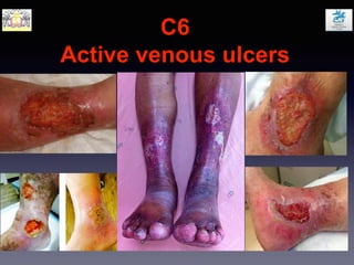 C6
Active venous ulcers
 