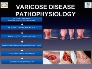 VARICOSE DISEASE
PATHOPHYSIOLOGYVALVE INCOMPETENCE
/CHRONIC VENOUS HYPERTENSION/
MICROCIRCULATION DYSFUNCTION
RED BLOOD CELL DIFFUSION/LYSIS
HAEMOSIDERIN DEPOSITION AROUND CAPILLARIES
CAPILLARY DAMAGE - DERMATITIS
CHRONIC VENOUS ULCERATION
 
