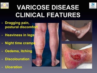VARICOSE DISEASE
CLINICAL FEATURES
• Dragging pain,
postural discomfort
• Heaviness in legs
• Night time cramps
• Oedema, itching
• Discolouration
• Ulceration
 