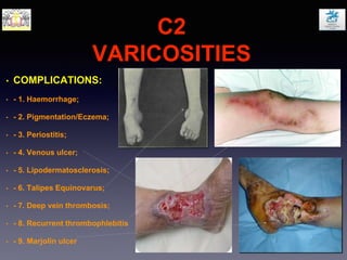 C2
VARICOSITIES
• COMPLICATIONS:
• - 1. Haemorrhage;
• - 2. Pigmentation/Eczema;
• - 3. Periostitis;
• - 4. Venous ulcer;
• - 5. Lipodermatosclerosis;
• - 6. Talipes Equinovarus;
• - 7. Deep vein thrombosis;
• - 8. Recurrent thrombophlebitis
• - 9. Marjolin ulcer
 