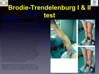 Brodie-Trendelenburg I & II
test
can be carried out as part of a physical examination
to determine the competency of the valves in the
superficial and deep veins of the legs in patients
with varicose veins.
With the patient in the supine position, the leg is
flexed at the hip and raised above heart level. The
veins will empty due to gravity or with the
assistance of the examiner's hand squeezing blood
towards the heart.
A tourniquet is then applied around the upper thigh
to compress the superficial veins but not too tight
as to occlude the deeper veins. The leg is then
lowered by asking the patient to stand.
Normally the superficial saphenous vein will fill from
below within 30–35 seconds as blood from the
capillary beds reaches the veins; if the superficial
veins fill more rapidly with the tourniquet in place
there is valvular incompetence below the level of
the tourniquet in the "deep" or "communicating"
veins. After 20 seconds, if there has been no rapid
filling, the tourniquet is released. If there is sudden
filling at this point, it indicates that the deep and
communicating veins are competent but the
superficial veins are incompetent
Superficial veins of the leg normally empty into
deep veins, however retrograde filling occurs when
valves are incompetent, leading to varicose veins.
 