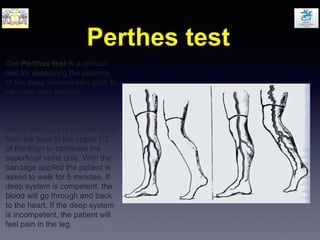 Perthes test
The Perthes test is a clinical
test for assessing the patency
of the deep femoral vein prior to
varicose vein surgery.
The limb is elevated and an
elastic bandage is applied firmly
from the toes to the upper 1/3
of the thigh to obliterate the
superficial veins only. With the
bandage applied the patient is
asked to walk for 5 minutes. If
deep system is competent, the
blood will go through and back
to the heart. If the deep system
is incompetent, the patient will
feel pain in the leg.
 