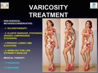 VARICOSITY
TREATMENT
• NON-SURGICAL
METHODS/CONSERVATIVE:
• - 1. SCLEROTHERAPY;
• - 2. ELASTIC BANDAGE, STOCKINGS,
GRADED COMPRESSION
STOCKINGS;
• - 3.PERIODIC LOWER LIMB
ELEVATION;
• - 4. WORK-OUT FOR LOW
EXTREMITY MUSCLES
• МEDICAL THERAPY:
• - 1. Venotonics;
• - 2. Flavonoids
 
