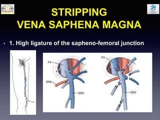 STRIPPING
VENA SAPHENA MAGNA
• 1. High ligature of the sapheno-femoral junction
 