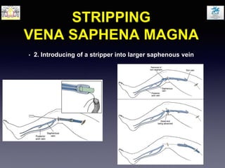 STRIPPING
VENA SAPHENA MAGNA
• 2. Introducing of a stripper into larger saphenous vein
 