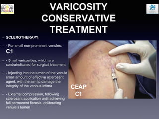 VARICOSITY
CONSERVATIVE
TREATMENT
• SCLEROTHERAPY:
• - For small non-prominent venules.
C1
• - Small varicosities, which are
contraindicated for surgical treatment
• - Injecting into the lumen of the venule
small amount of effective sclerosant
agent, with the aim to damage the
integrity of the venous intima
• - External compression, following
sclerosant application until achieving
full permanent fibrosis, obliterating
venule’s lumen
CEAP
C1
 