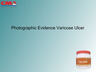 Photographic Evidence Varicose Ulcer  