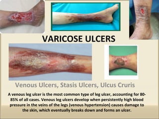 VARICOSE ULCERS
Venous Ulcers, Stasis Ulcers, Ulcus Cruris
A venous leg ulcer is the most common type of leg ulcer, accounting for 80-
85% of all cases. Venous leg ulcers develop when persistently high blood
pressure in the veins of the legs (venous hypertension) causes damage to
the skin, which eventually breaks down and forms an ulcer.
 