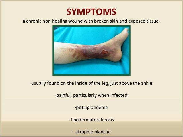 varicose-ulcers