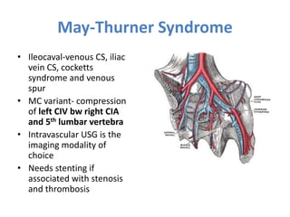 May-Thurner Syndrome
• Ileocaval-venous CS, iliac
vein CS, cocketts
syndrome and venous
spur
• MC variant- compression
of left CIV bw right CIA
and 5th lumbar vertebra
• Intravascular USG is the
imaging modality of
choice
• Needs stenting if
associated with stenosis
and thrombosis
 