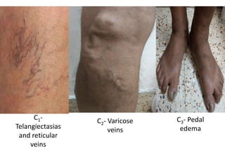 C1-
Telangiectasias
and reticular
veins
C2- Varicose
veins
C3- Pedal
edema
 