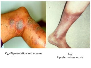 C4a- Pigmentation and eczema C4b-
Lipodermatosclerosis
 