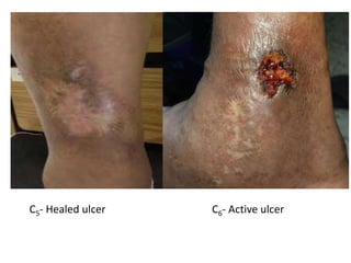 C5- Healed ulcer C6- Active ulcer
 