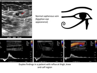 Duplex findings in a patient with reflux at thigh, knee
and calf region
Normal saphenous vein
(Egyptian eye
appearance)
 
