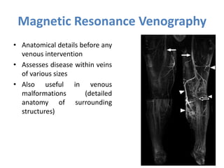Magnetic Resonance Venography
• Anatomical details before any
venous intervention
• Assesses disease within veins
of various sizes
• Also useful in venous
malformations (detailed
anatomy of surrounding
structures)
 