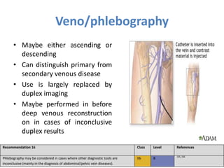 Veno/phlebography
• Maybe either ascending or
descending
• Can distinguish primary from
secondary venous disease
• Use is largely replaced by
duplex imaging
• Maybe performed in before
deep venous reconstruction
on in cases of inconclusive
duplex results
 