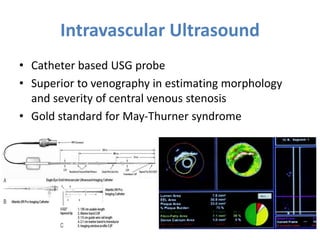 Intravascular Ultrasound
• Catheter based USG probe
• Superior to venography in estimating morphology
and severity of central venous stenosis
• Gold standard for May-Thurner syndrome
 