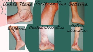 Ankle Flare Varicose Vein Oedema
Eczema Healed ulceration Active
ulceration
 