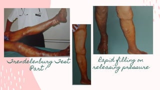 Trendelenburg Test
Part 1
Rapid filling on
releasing pressure
 