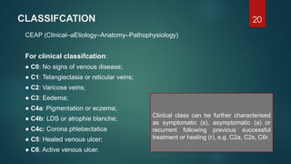 Varicose veins .pptx