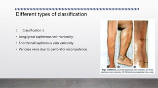 Veines Classification Varicose vein- Kavo.pptx