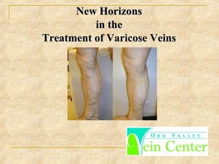 New HorizonsNew Horizons
in thein the
Treatment of Varicose VeinsTreatment of Varicose Veins
 