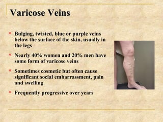 Varicose VeinsVaricose Veins
 Bulging, twisted, blue or purple veins
below the surface of the skin, usually in
the legs
...