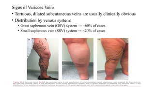 VARICOSE VEINS and its management for study purposes and teaching | PPTX