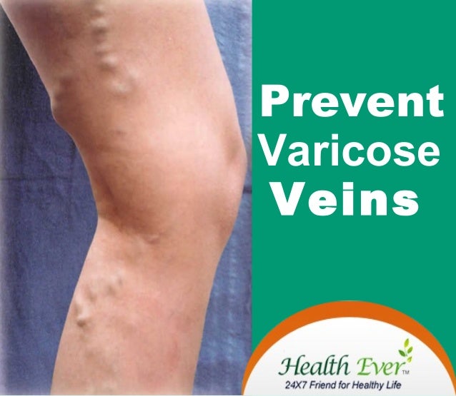 Prevent Varicose Veins