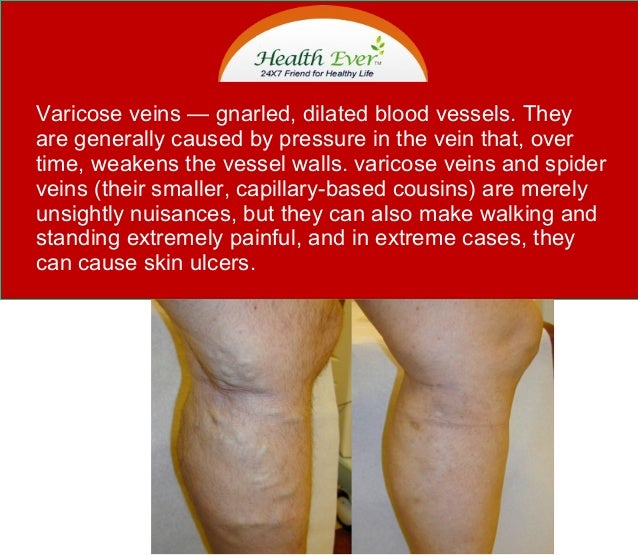 Prevent Varicose Veins