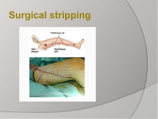 Surgical stripping
 