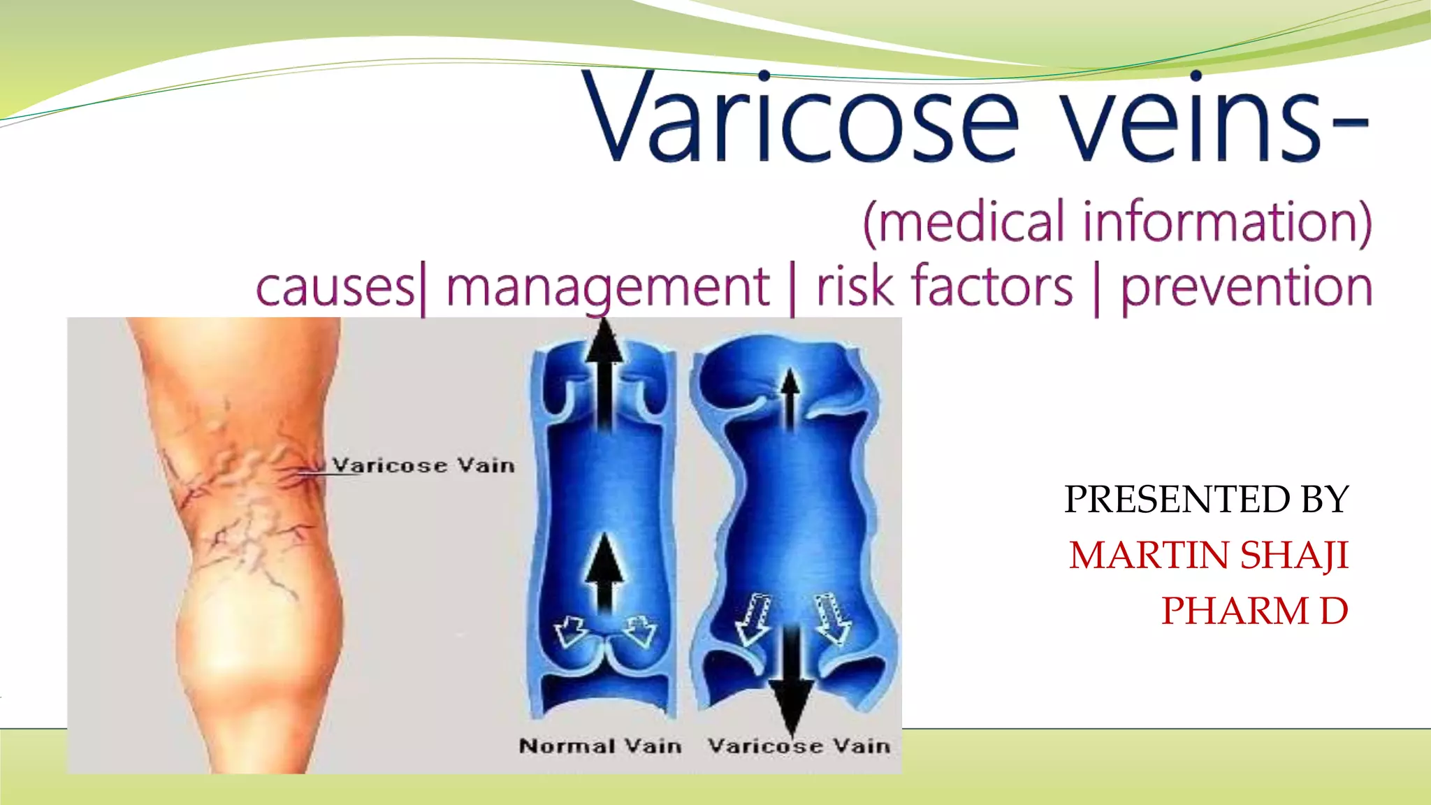 Varicose veins (medical information) causes, manag, risk factors