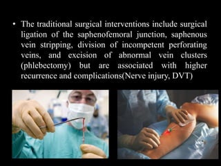 Diagnosis and radiological management of varicose vein | PPTX