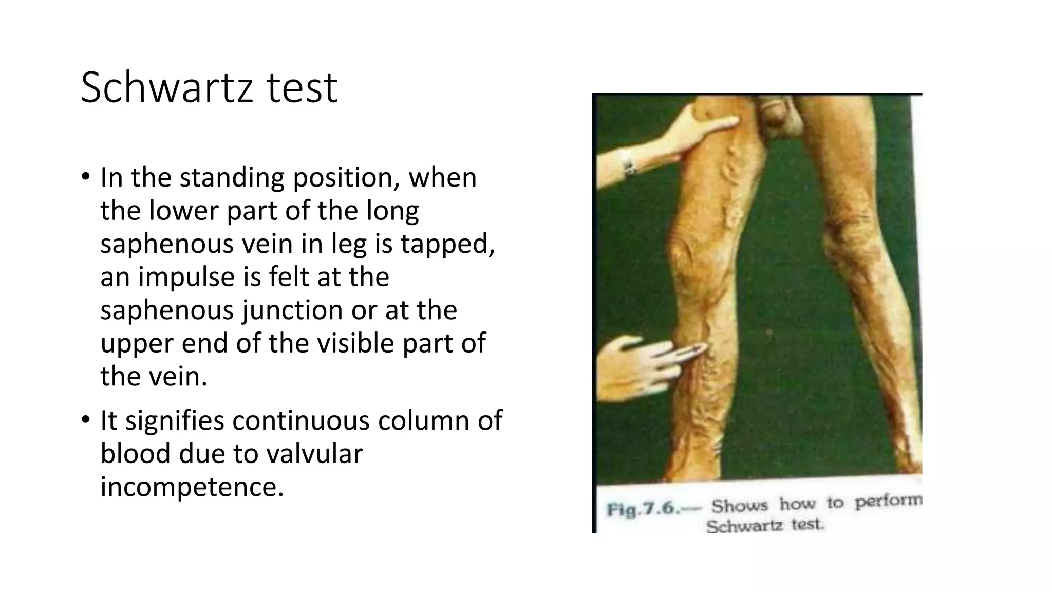 Varicose Veins | PPTX