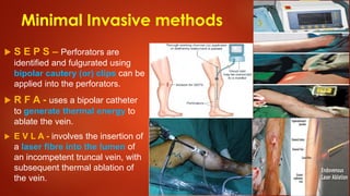 Fulgurated Varicose Veins - C/F, Investigations & Treatment | PDF
