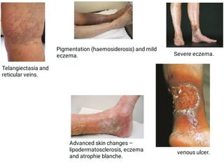 VARICOSE VEINS direct slides ppt lecture hall | PDF