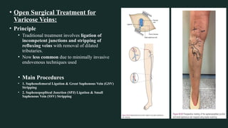 Comprehensive Overview of Lower Limb Venous System and Varicose Vein ...