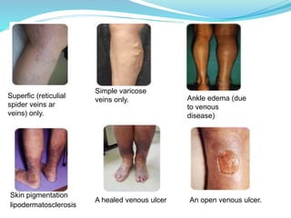 Superfic (reticulial
spider veins ar
veins) only.
Simple varicose
veins only. Ankle edema (due
to venous
disease)
Skin pigmentation
lipodermatosclerosis
A healed venous ulcer An open venous ulcer.
 