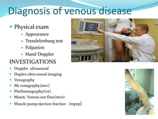  Physical exam
 Appearance
 Trendelenburg test
 Palpation
 Hand Doppler
INVESTIGATIONS
 Doppler ultrasound
 Duplex ultra sound imaging
 Venography
 Mr venography(mrv)
 Plethismography(vrt)
 Maxm. Venous out flow(mvo)
 Muscle pump ejection fraction (mpep)
Diagnosis of venous disease
 