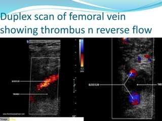 Duplex scan of femoral vein
showing thrombus n reverse flow
*Image via Bing
 