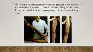 (b) To test the communicating system, the pressure is not released
but maintained for about 1 minute. Gradual filling of the veins
during the period indicates incompetency of the communicating
veins.
4/4/2019Shubham Gupta ©
 