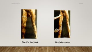 Fig : Perthes’ test Fig : Schwartz test
4/4/2019Shubham Gupta ©
 