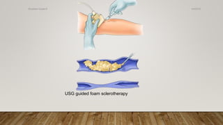 USG guided foam sclerotherapy
4/4/2019Shubham Gupta ©
 